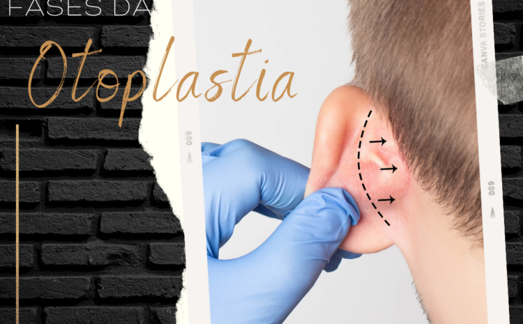  Fases da Otoplastia