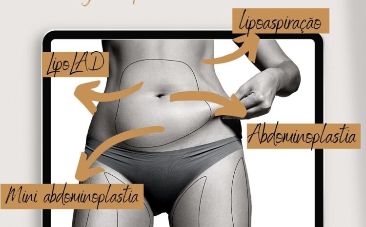  Tipos de gordura abdominais e cirurgias plásticas indicadas