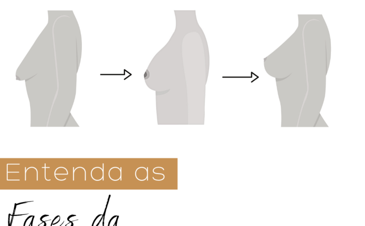  As fases da mamoplastia