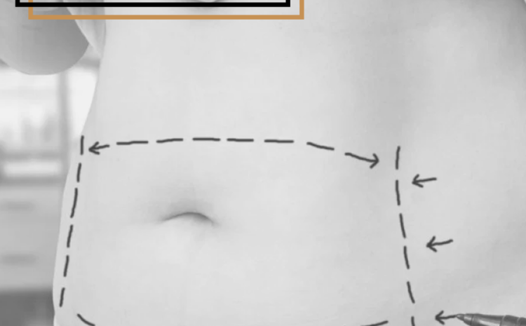  Abdominoplastia